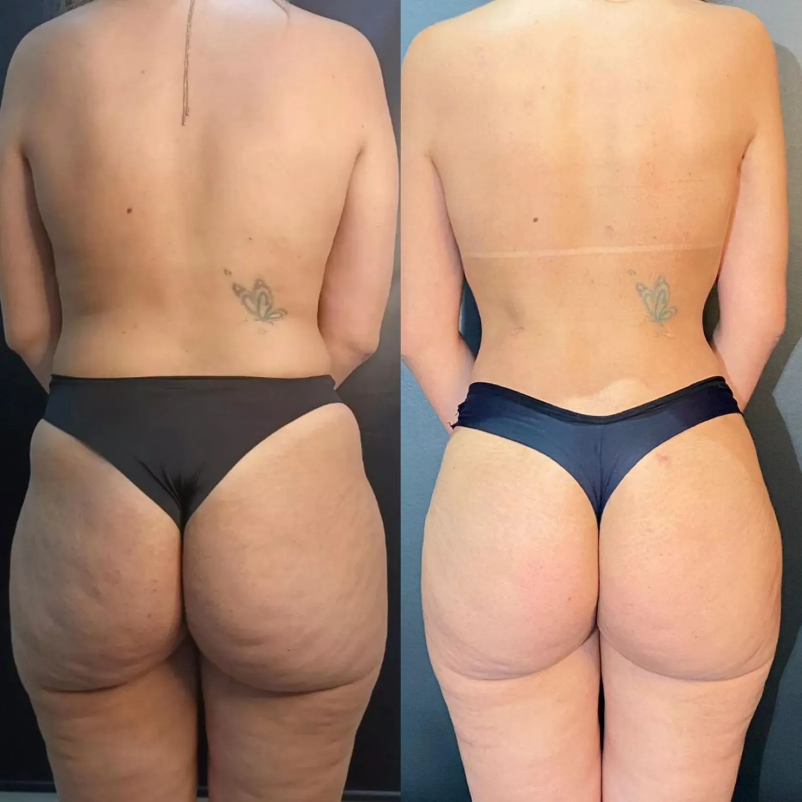 Antes e depois de Remodelação Glútea Ultrassônica na Unique